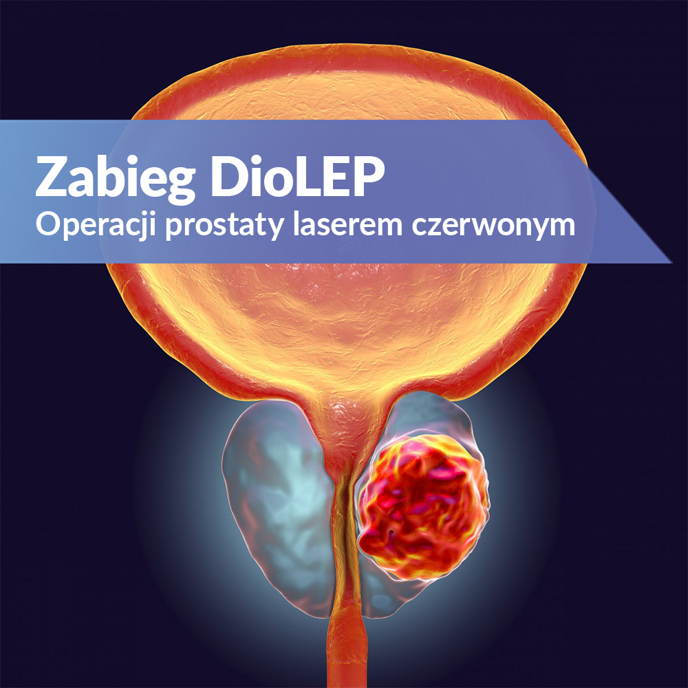 Enukleacja prostaty DioLEP