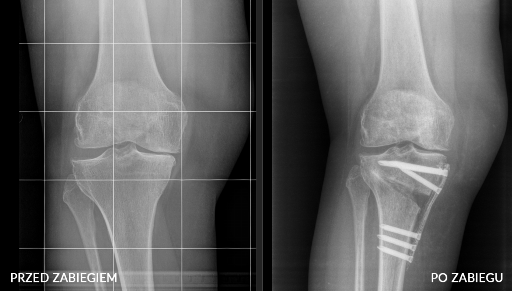 Innowacyjna technika osteotomii HTO - technologia druku 3D